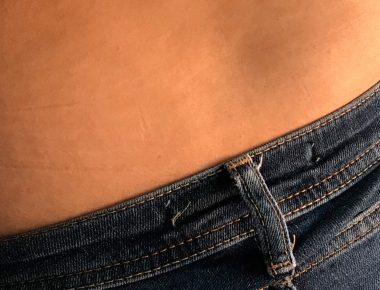 Tips para desvanecer las estrías